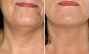 invecchiamento collo prima e dopo il trattamento. benessere ringiovanimento medicina estetica