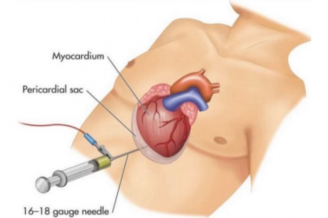Cardio-Oncologia, uno studio modenese pubblicato sulla rivista Internal and Emergency Medicine