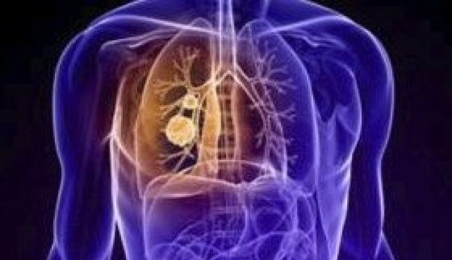 Tumori al polmone, prima conferma del legame diretto con l&#039;inquinamento